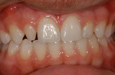 teeth before